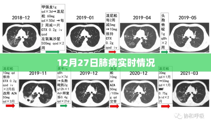 肺病实时更新，最新消息与状况分析（12月27日）