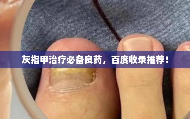 灰指甲治疗必备良药，百度收录推荐！