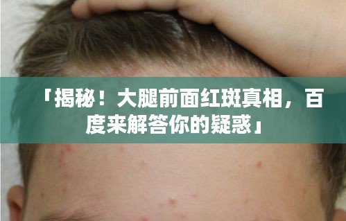 「揭秘！大腿前面红斑真相，百度来解答你的疑惑」
